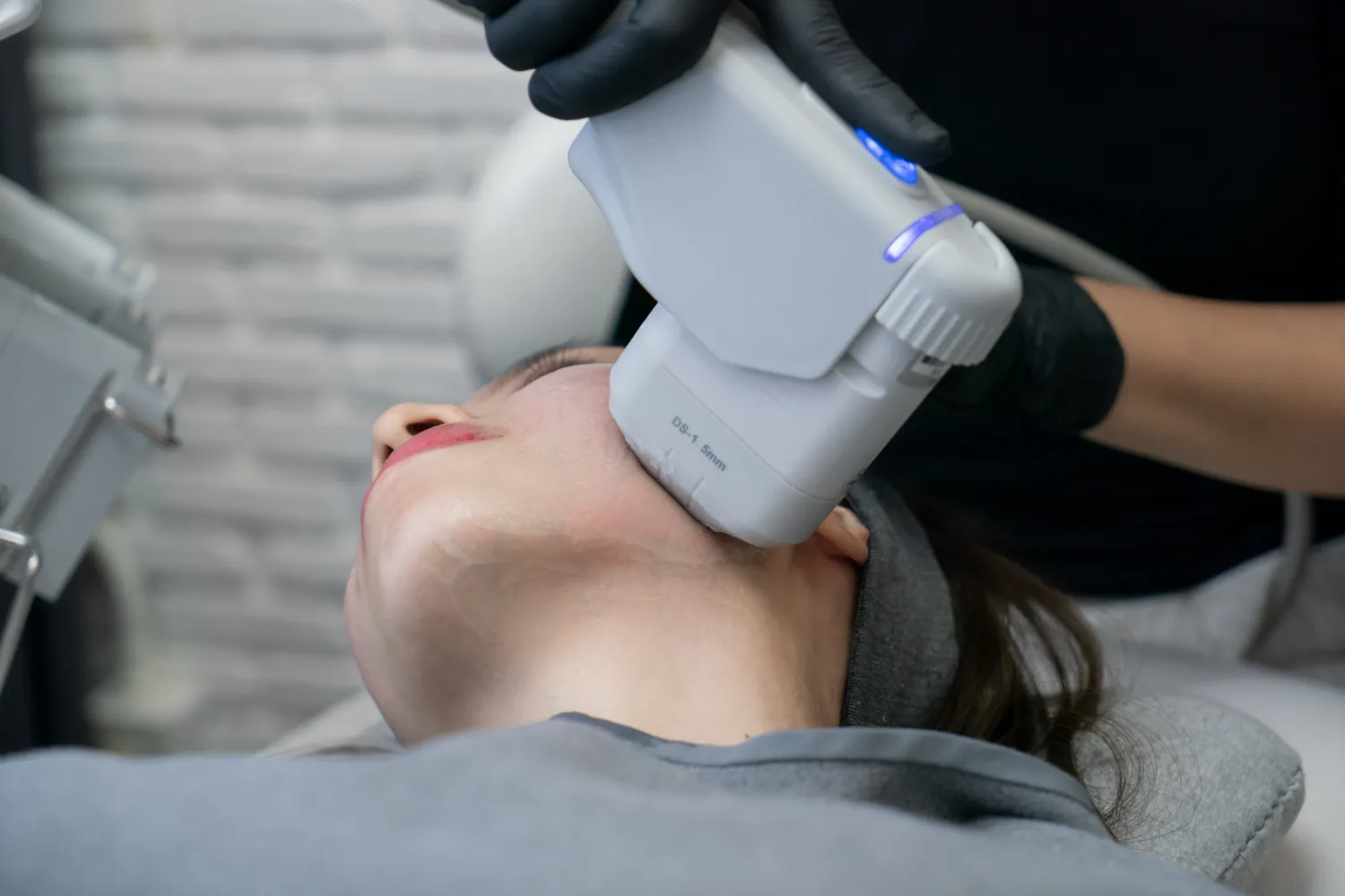Zabieg HIFU (High-Intensity Focused Ultrasound)